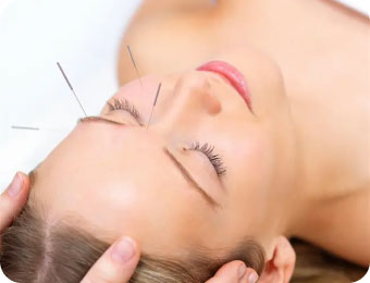 Acupuncture