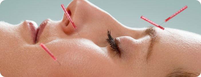 Cosmetic Acupuncture