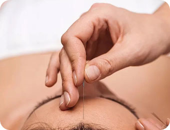 Acupuncture